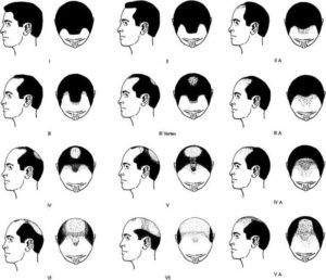 Will Your Mature Hairline Turn Into Male Pattern Baldness