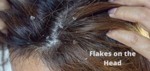 Smelly scalp syndrome and scalp dandruff