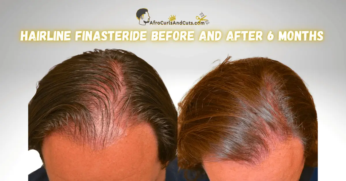 Finasteride Results After 6 Months before and after for hairline